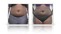 Bodytite liposuction.