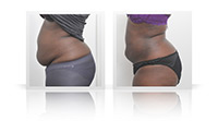 Bodytite liposuction.