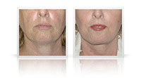 Facelift, neck lift, fat transfer.