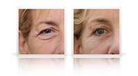 Upper and lower eyelid blepharoplasty; relatively advanced skin laxity related to combination of sun damage and changes associated with ageing, leading to significant lateral hooding for the upper eyelid, festoons of orbicularis muscle distorting the lower