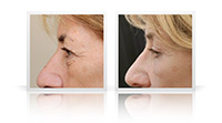 Upper and lower eyelid blepharoplasty; relatively advanced skin laxity related to combination of sun damage and changes associated with ageing, leading to significant lateral hooding for the upper eyelid, festoons of orbicularis muscle distorting the lower