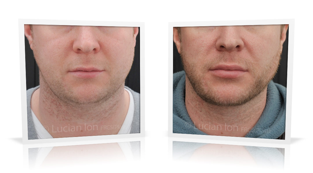 Buccal fat pad / buccal fat pad before and after photos - buccal fat pad  surgery London