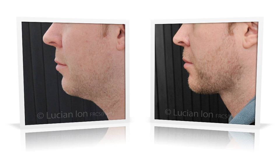 Buccal fat pad / buccal fat pad before and after photos - buccal