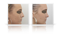 Reduction of the nasal bump, contouring of the tip of the nose.