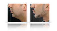 Facial sculpting, chin and jaw implants, anterior neck left.