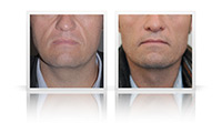 Anterior necklift, liposuction to jawline.