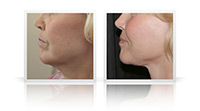 Secondary facelift, Neck lift.