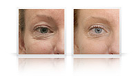 Eyelid lift, cheek lift.