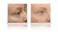 Eyelid lift, cheek lift.