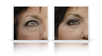 Blepharoplasty.