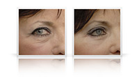 Blepharoplasty.