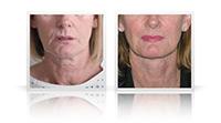 Facelift with neck lift and small fat transfer to midface.