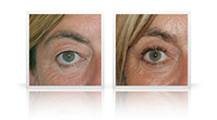 Upper and lower eyelid surgery combined with endoscopic brow lift.