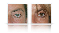 Upper and lower eyelid surgery combined with endoscopic brow lift.