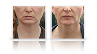 Neck Lift, chin remodeling.