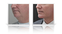 Anterior neck lift, chin implant.