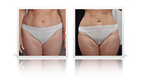 Bodytite liposuction.