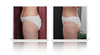 Bodytite liposuction.