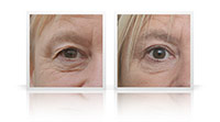 Upper and lower eyelid blepharoplasty.