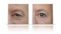 Upper and lower eyelid blepharoplasty.