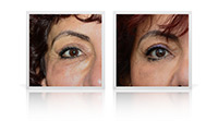 Blepharoplasty