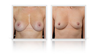 Breast Implants removal, Mastopexy