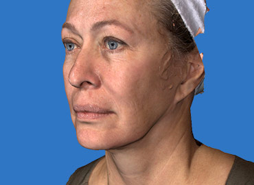 Facial Sculpting 3d Simulation