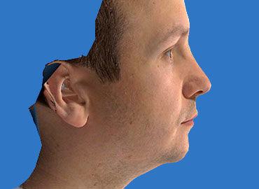 Nasal Length Rhinoplasty Simulation