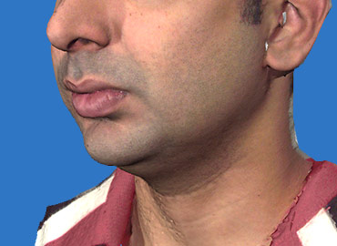 Chin and Jaw Angle Rejuvenation