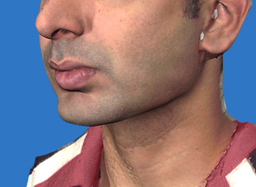 Chin and Jaw Angle Rejuvenation