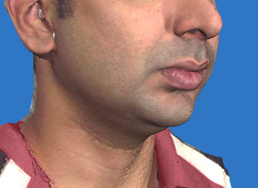 Facial Sculpting 3d Simulation