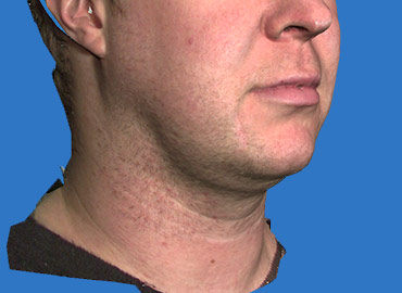 Neck Rejuvenation