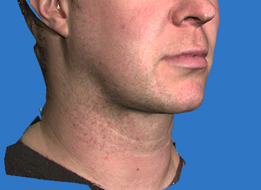 Neck Rejuvenation