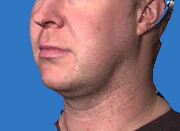 Facial Sculpting 3d Simulation