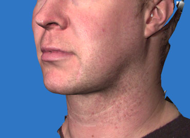 Facial Sculpting 3d Simualtion