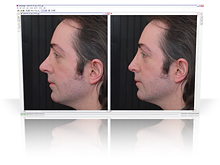 2d rhinoplasty simulation