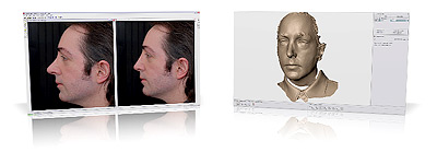 2D and 3D rhinoplasty simulation